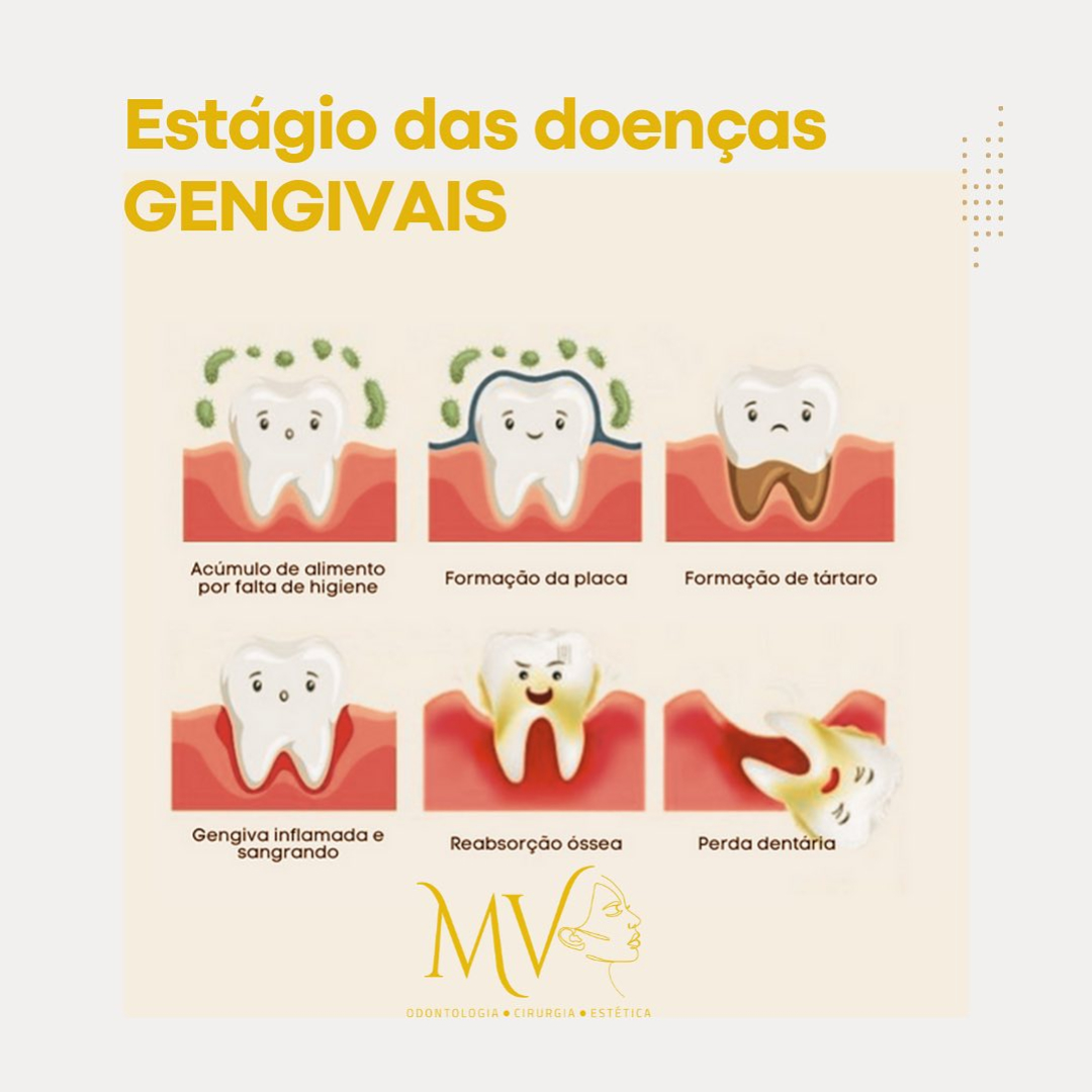 Estágios das doenças gengivais-Saiba mais