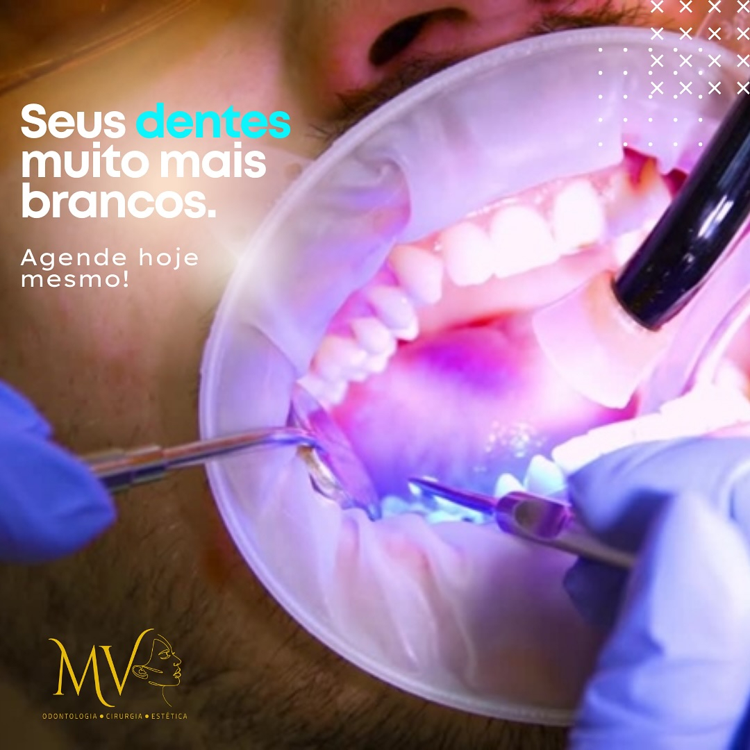 Clareamento Dental-seus dentes muito mais brancos