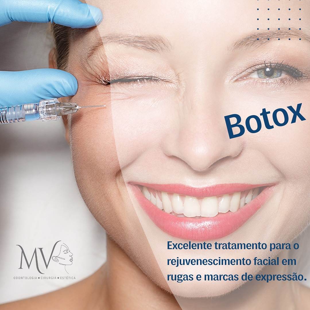 Botox- O Segredo para um Rosto Mais Jovem! 