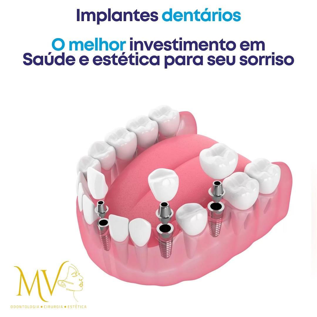 Implantes Dentários-Um Investimento em Saúde e Beleza