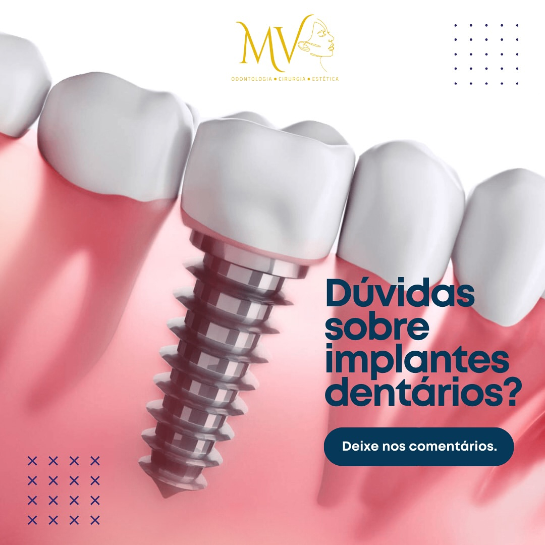 Implantes dentários-Tem dúvidas sobre isso ?