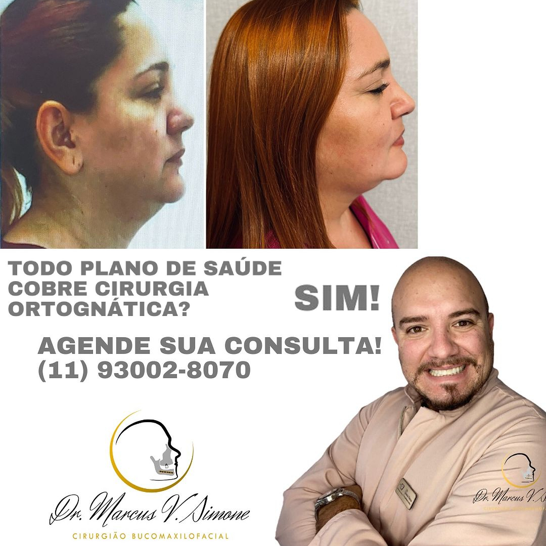 Todo plano de Saúde cobre cirurgia Ortognática ?-Saiba mais !