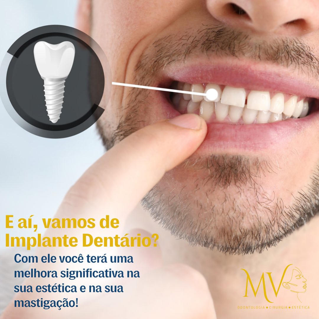 Implantes dentários-Melhore a sua estética dental