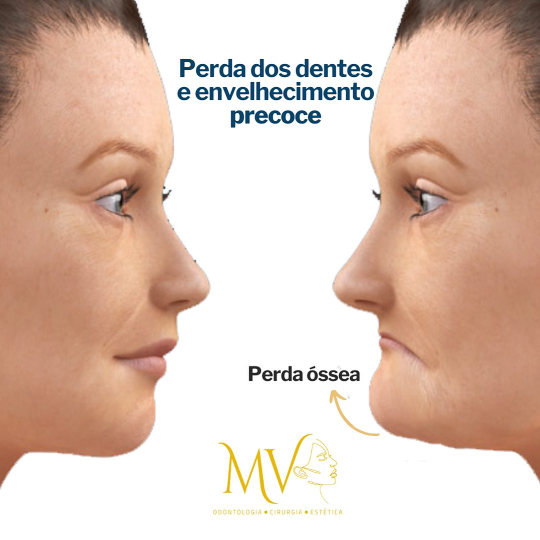 Perda de dentes e envelhecimento precoce-Saiba mais